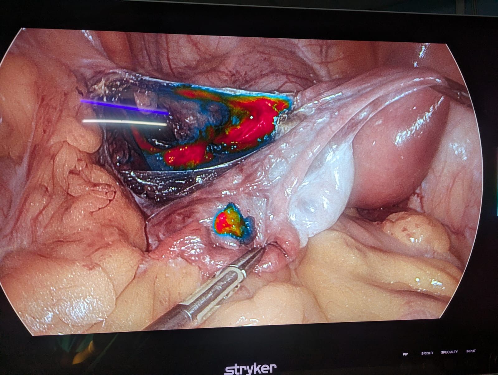 Dr. Mariam Anjum — Sentinel Lymph Node